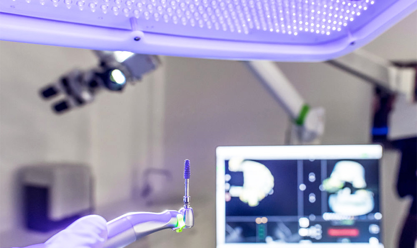 Dental implant with 4.0 technology: painless and safe with navigation system